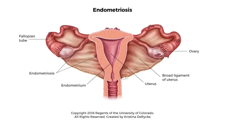 Endometriosis